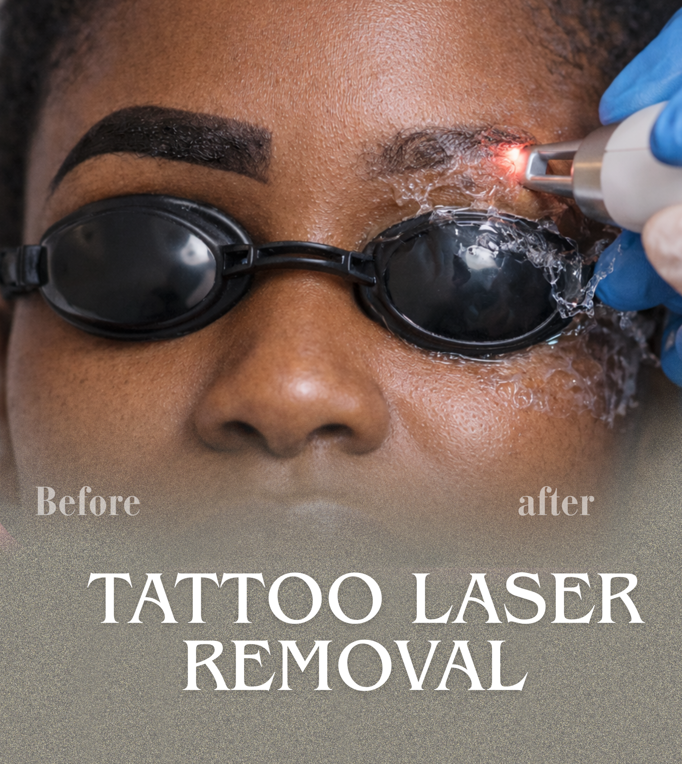 Pico laser treatment service