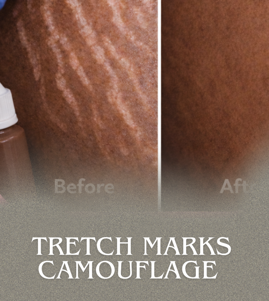Scar and stretch mark camouflage treatment